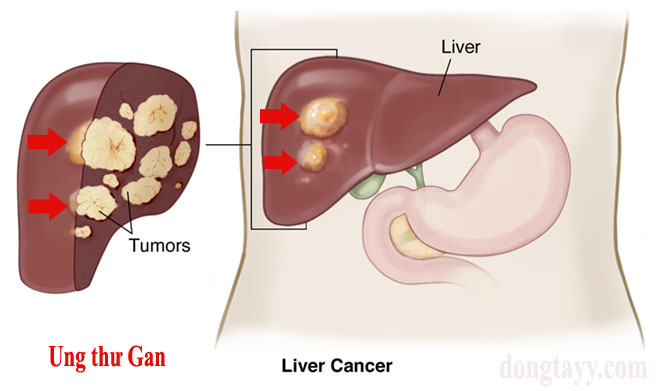 Bệnh ung thư gan