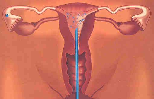  Hiệu quả của bơm tinh trùng vào buồng tử cung điều trị vô sinh chưa rõ nguyên nhân
