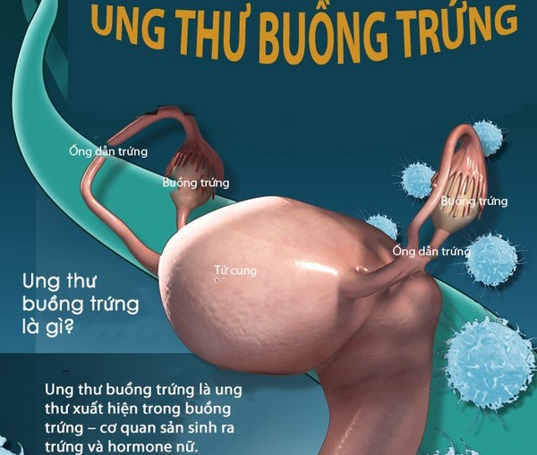 Biểu hiện của ung thư buồng trứng dễ nhầm với hội chứng ruột kích thích