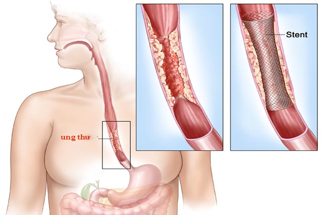 ung thư thực quản