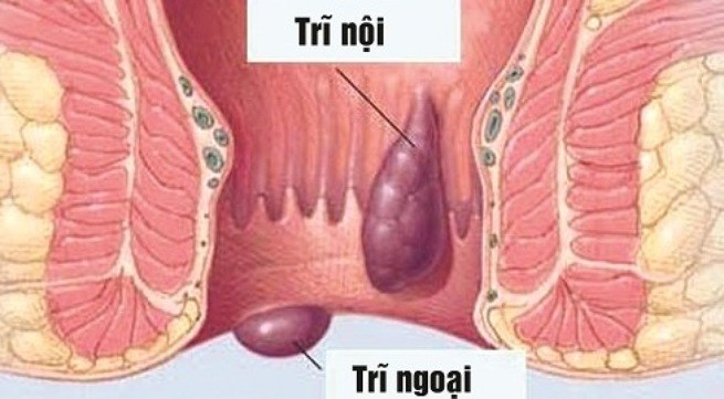 Bệnh trĩ nội và trĩ ngoại