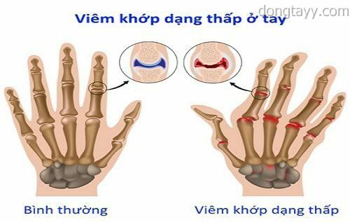 Viêm khớp dạng thấp