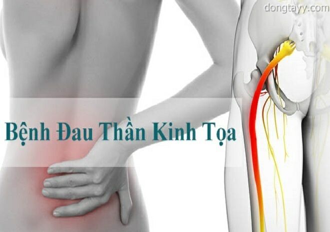 thuốc đặc trị đau dây thần kinh tọa