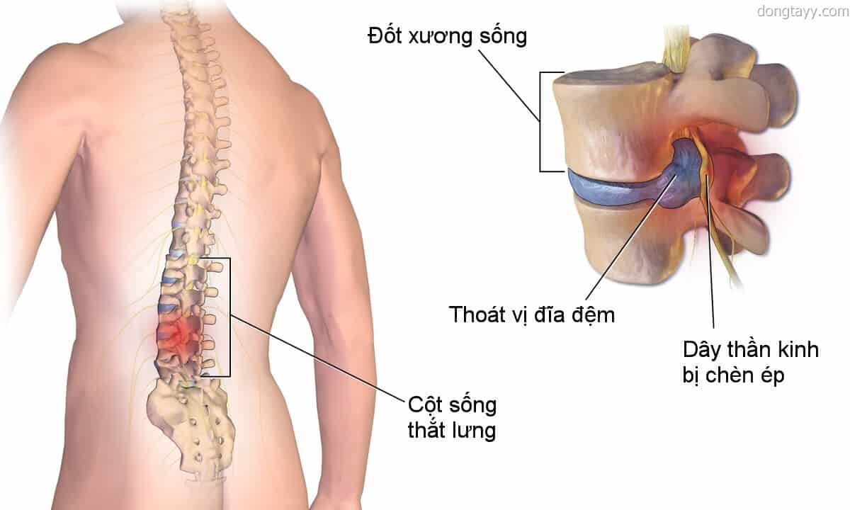 Đau thắt lưng