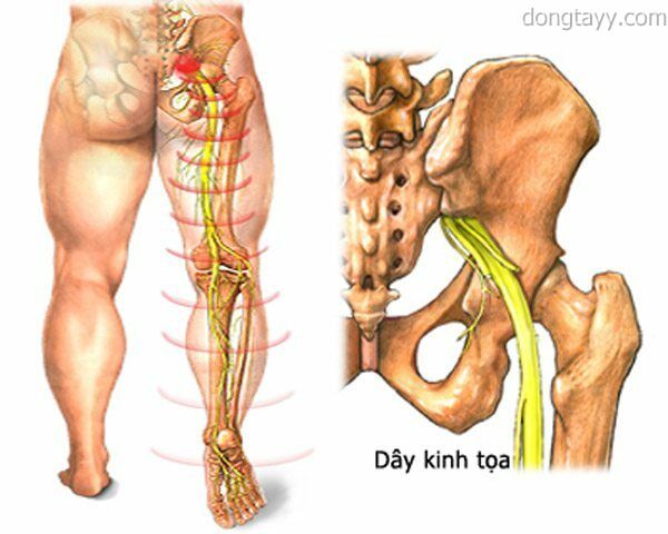 Một số bài thuốc chữa đau thần kinh tọa