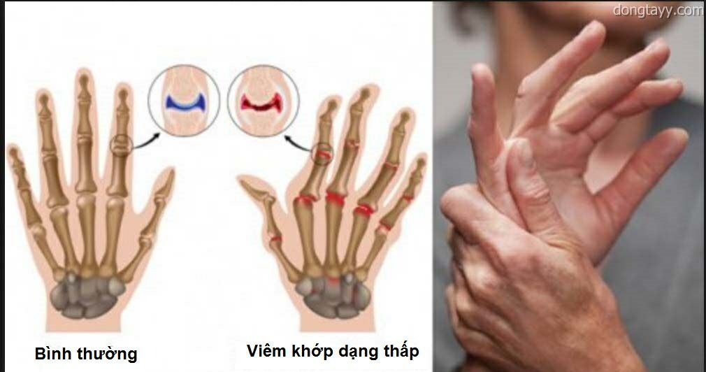 bài thuốc dân gian chữa viêm khớp dạng thấp