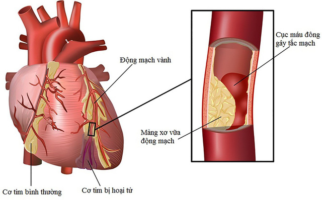 Loạn nhịp tim