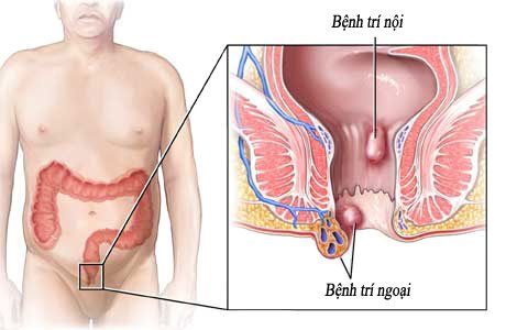 Phòng ngừa bệnh trĩ tái phát