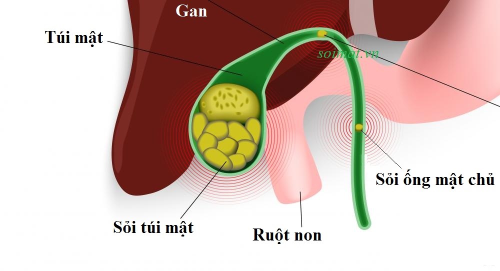 5 bài thuốc trị sỏi mật hiệu quả