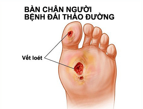 Những bài thuốc hay chữa bệnh tiểu đường