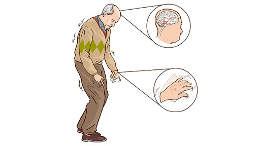 Bệnh Parkinson có liên quan tới gen miễn dịch