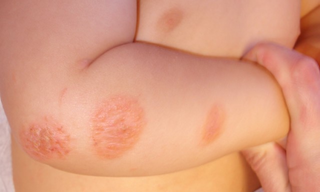 Bệnh nấm da thường gặp trong mùa nóng