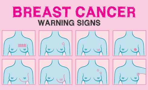 Cứ 10 phụ nữ thì có 1 người bị mắc bệnh ung thư vú