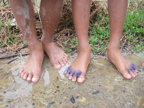 Bệnh ngoài da: Phòng và chữa nước ăn chân