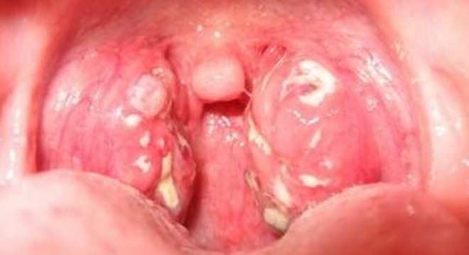 Biểu hiện giai đoạn đầu của bệnh ung thư vòm họng