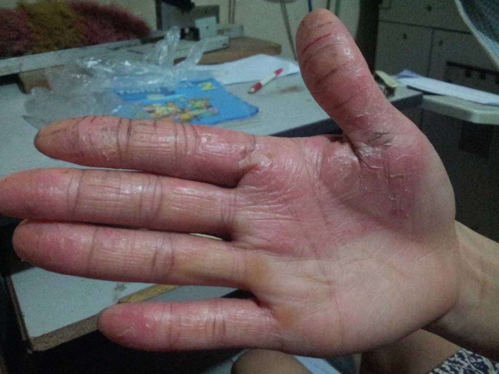 Bệnh ngoài da: Chữa nứt nẻ tay, chân bằng y học cổ truyền