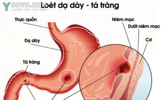 Các bài thuốc trị viêm loét dạ dày, viêm loét tá tràng