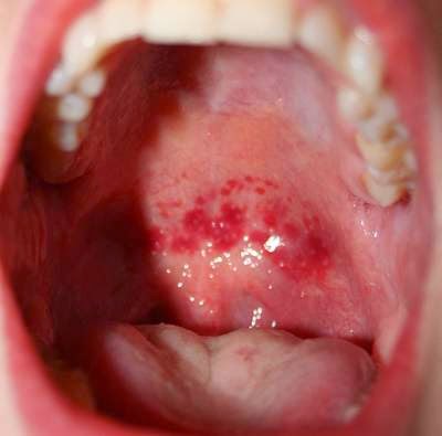 Dấu hiệu của ung thư vòm họng