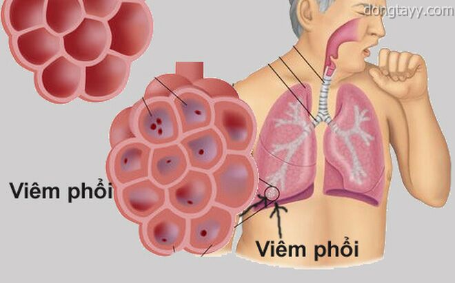 Mùa xuân người cao tuổi cần đề phòng viêm phổi