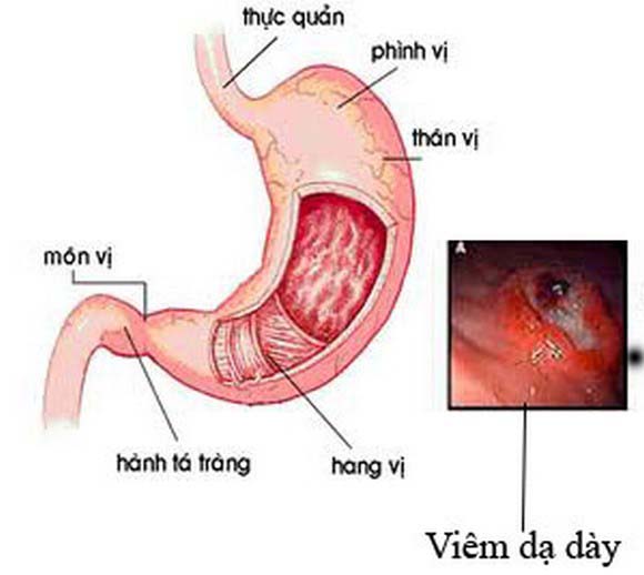 Món ăn, thuốc chữa viêm loét dạ dày, tá tràng cực đơn giản tại nhà