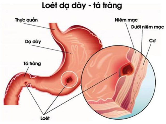 Chè dây chữa loét dạ dày