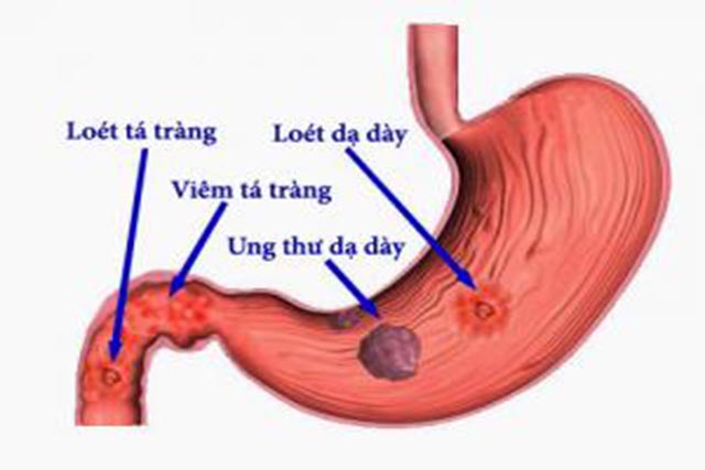 Cứ 10 người Việt Nam thì có 7 người có nguy cơ bị mắc bệnh ung thư dạ dày.