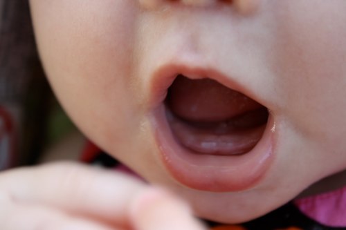 Nguyên nhân viêm nướu răng ở trẻ nhỏ
