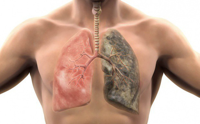 Bệnh phổi: Cảnh báo phổi mắc bệnh từ triệu chứng ho khạc đờm