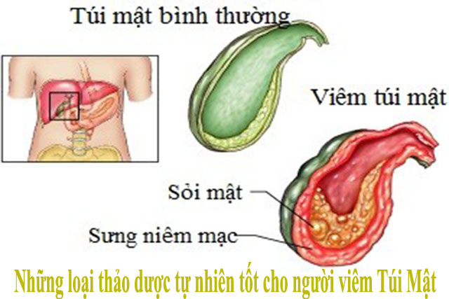 Những loại thảo dược tự nhiên tốt cho người viêm Túi Mật