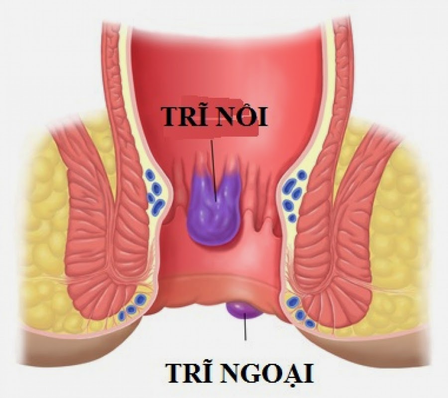 Thuốc ngâm phòng chống bệnh trĩ