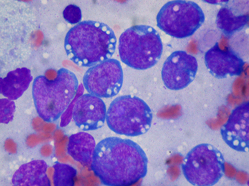 Ung Thư Hạch Bạch Huyết (Lymphoma)