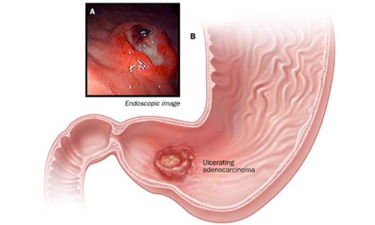ung thư dạ dày