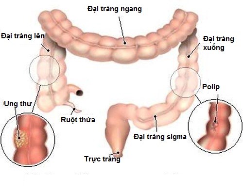 Ung thư đại trực tràng những dấu hiệu đầu tiên bạn cần biết