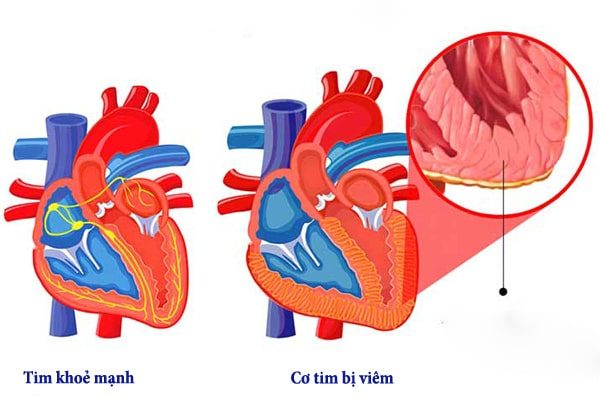 Hiểm họa từ viêm cơ tim