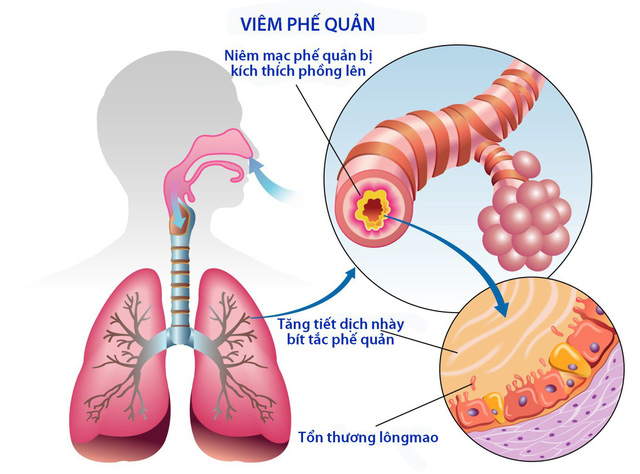 Những bài thuốc đông y trị bệnh viêm phế quản