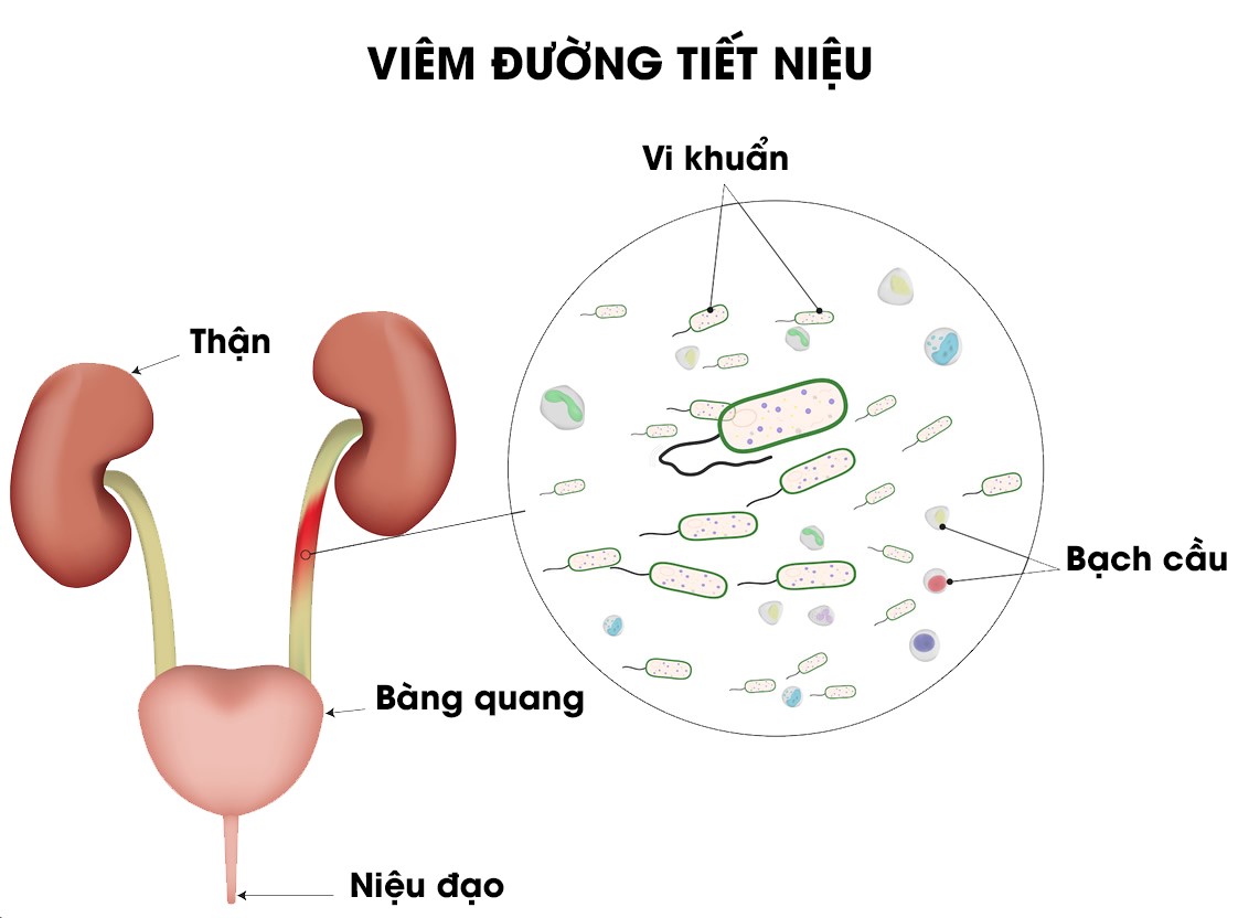 Bài thuốc nam chữa viêm đường tiết niệu, Chữa sỏi niệu đạo, sỏi thận, sỏi túi mật...