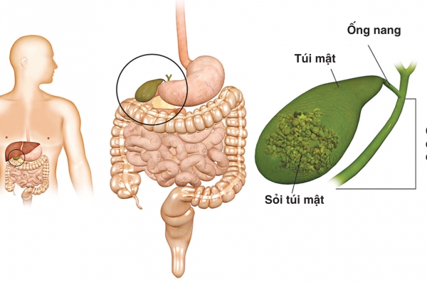 sỏi mật